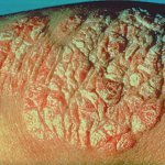 psoriasis