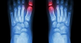 rheumatoid arthritis