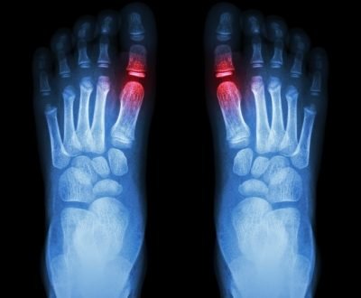 rheumatoid arthritis