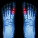 Hadir Obat Biosimilar Flixabi Untuk Artritis Reumatoid Dengan BIaya Lebih Hemat