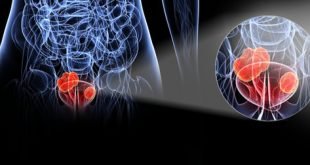 kanker kandung kemih