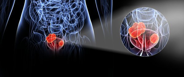 kanker kandung kemih