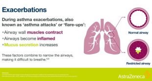 eksaserbasi asma