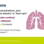 Hasil Uji Klinik Obat Baru Antibodi Monoklonal Untuk Asma Berat Menggembirakan