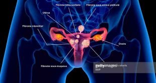 fibroid uteri