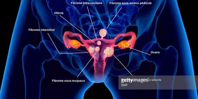 fibroid uteri