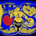 Terapi Baru Untuk Kanker Ginjal dengan Obat Kombinasi Hadir di Amerika
