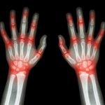 5 Hal Krusial dalam Konseling Tentang Asam Urat Untuk Para Apoteker