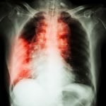 Olmutinib, Calon Terapi Baru Untuk Kanker Paru-Paru yang Lolos Uji Klinik 2