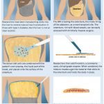 Pasien Diabetes Tipe 1 Akhirnya Bisa Terbebas Insulin Melalui Transplantasi Sel