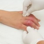 Alasan Ilmiah Lamanya Waktu Penyembuhan Luka Pada Penyakit Kronis