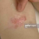 Setelah 15 Tahun, Akhirnya Muncul Salep Crisaborole yang Efektif Untuk Eksim