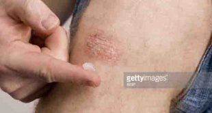 psoriasis