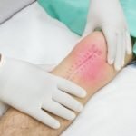 Peneliti Temukan Cara Agar Luka Tidak Berbekas