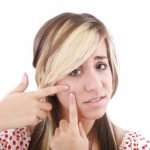 5 Cara Mengatasi Jerawat yang Benar Menurut Apoteker