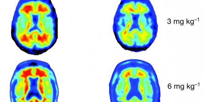 amyloid-plaques-aducanumab