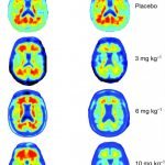 Obat Alzheimer Baru Mampu Hilangkan Protein Toksik pada Otak dan Perlambat Hilangnya Memori