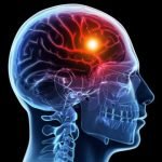 Kajian Obat Semax® : Obat Stroke dengan Penggunaan dan Izin Khusus dari BPOM