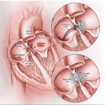 Telah Hadir Alat Canggih Tanpa Operasi yang Bisa Mencegah Kambuhnya Stroke