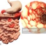 Ustekinumab, Obat Terapi Biologis Bertarget Interleukin Pertama Untuk Penyakit Crohn