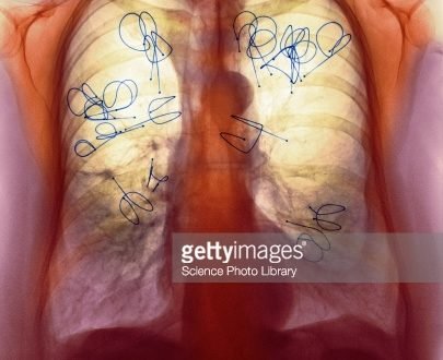 tuberculosis