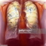 Alasan Mengapa Terapi HIV dan Tuberkulosis Dikaitkan dengan Defisiensi Vitamin D