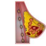 Obat Kanker Ovarium Lynpara (olaparib) Berpotensi Untuk Terapi Baru Kanker Payudara