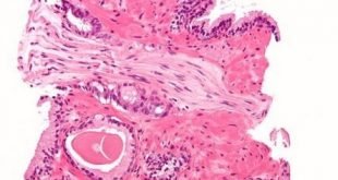 Treatment uses light and deep-sea bacteria to kill cancer cells | Pharmafile 2016-12-21 21-17-53