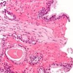 Teknik Terapi Baru dengan Bakteri Laut Mampu Membunuh Sel Kanker Prostat