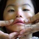 BPOM : Obat Peginterferon alfa-2a Untuk Hepatitis B dan C Berisiko Kelumpuhan di Wajah