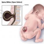 Konsumsi Asam Folat Sebelum dan Selama Kehamilan Mencegah Cacat Tabung Saraf Janin