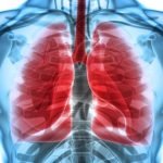 Nivolumab, Terapi Imun Baru untuk Kanker Paru-Paru