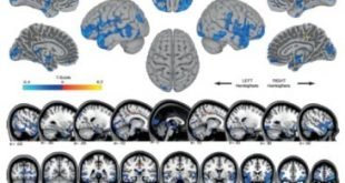 Warna biru menunjukkan area penurunan volume materi abu-abu, mungkin mencerminkan pergeseran cairan cerebrospinal. Oranye menunjukkan daerah meningkatnya volume materi abu-abu, di daerah yang mengontrol pergerakan kaki. Ini mungkin mencerminkan plastisitas otak yang berhubungan dengan "belajar bagaimana untuk bergerak di mikro". Ini adalah gambar pertama perubahan struktur otak pada manusia yang melakukan perjalanan luar angkasa. Credit: Image courtesy of University of Michigan