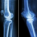 Obat Osteoporosis Berpotensi Membuat Tulang Lebih Rapuh Dalam Jangka Panjang