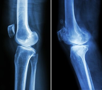 Obat Osteoporosis Berpotensi Membuat Tulang Lebih Rapuh ...