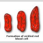 Setelah Menunggu 20 Tahun, Obat Baru Untuk Penyakit Anemia Sel Sabit Siap Dipasarkan