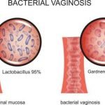 FDA Menyetujui Granul Oral Pertama dengan Dosis Tunggal untuk Pengobatan Infeksi Vaginal Karena Bakteri