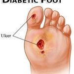 Terapi Luka Kronis Diabetes Melitus dengan Menggunakan Faktor Pertumbuhan