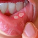 6 Kasus Efek Samping Serius Obat Sariawan Konsentrat Policresulen di Indonesia