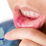 PT. Pharos : Kami Akan Perbaiki Label Albothyl Untuk Sariawan