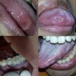 Penjelasan Kasus Policresulen Menurut Dokter Spesialis Penyakit Kulit