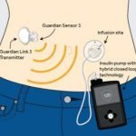 Pankreas Buatan Terbukti Dapat Mengontrol Gula Darah Pada Pasien Diabetes Tipe 2