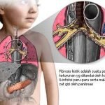 Obat Pertama Fibrosis Kistik Untuk Anak 2-5 Tahun Dipasarkan di AS
