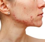 Sarecycline (Seysara), Antibiotik Baru untuk Mengobati Jerawat