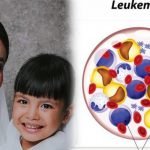 IDHIFA, Obat Masa Depan Untuk Leukemia Myeloid Akut (AML) di Indonesia