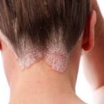 LIBTAYO® (Cemiplimab), Obat Baru Kanker Kulit Pertama dalam Bentuk Injeksi Imunoterapi