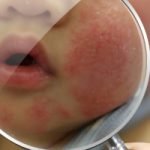 Krim TRPV1, Terapi Baru untuk Dermatitis Atopik