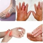 Upadacitinib, Pilihan Baru Pengobatan Rheumatoid Arthritis