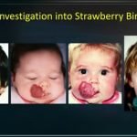 Tanda Lahir "Strawberry" pada Bayi bantu Temukan Terapi Kanker Baru