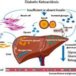 Mengenal Beta Keton, Penanda Diabetes Tipe 1 pada Sensor Elektrokimia